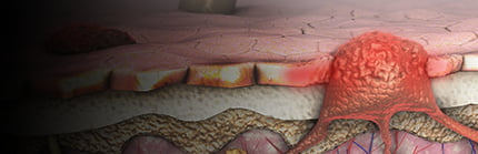 Skin Cancers herobanner
